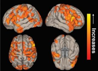 Brain network activity can improve in epilepsy patients after surgery