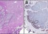 Potential Metastatic Prostate Cancer Biomarker Identified