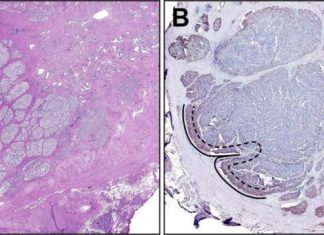 Potential Metastatic Prostate Cancer Biomarker Identified