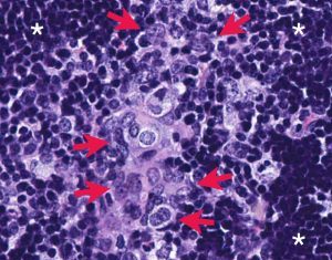 Prostate Cancer Target Blockade Tackles Elusive Onocogene