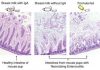 Breastmilk’s IgA Protects Preemies from Deadly Disease