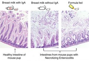 Breastmilk’s IgA Protects Preemies from Deadly Disease