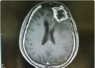 CAR-T cells used to target glioblastoma