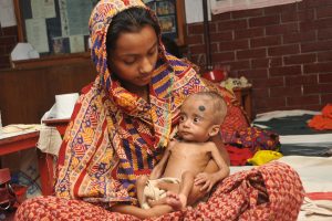 Microbiome Repairing Food for Malnourished Children Beats Current Therapy