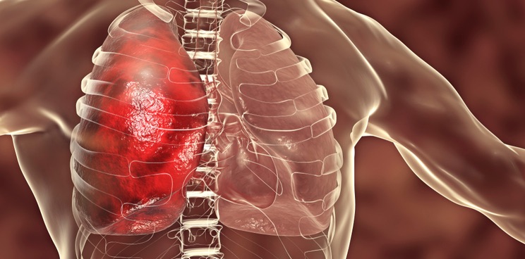 what is the treatment for pneumonia