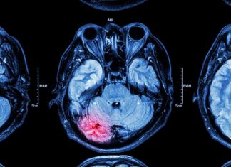 UTSA reduces seizures by removing newborn neurons