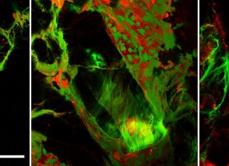 Neutrophils Shown to Play the Key Role in Gallstone Formation