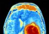 Novel Pathway for the Potential Treatment of Childhood Gliomas Discovered