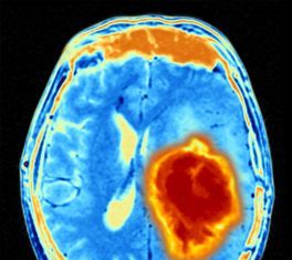 Novel Pathway for the Potential Treatment of Childhood Gliomas Discovered