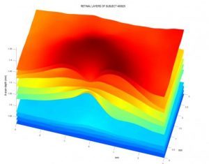 Alzheimer’s Disease Shows Up Early as Retinal Thinning and Thickening