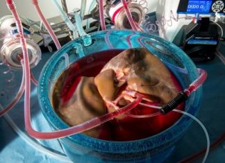 Supercooling helps preserve human transplant organs longer