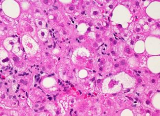 Drug reverses signs of liver disease in people living with HIV