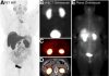 PET offers more precise screening method to select candidates for radionuclide therapy