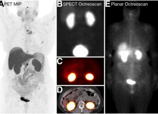 PET offers more precise screening method to select candidates for radionuclide therapy