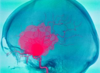 Study offers promising methodology to capture biomechanical behaviour of aneurysm