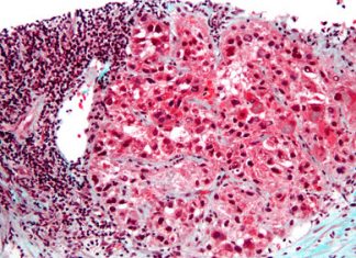 Tecentriq-Avastin combo hits endpoint in liver cancer – European Biotechnology