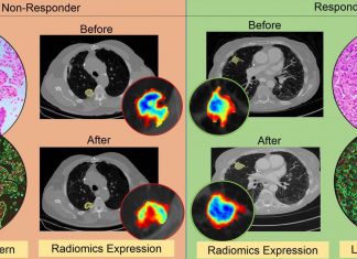 Using artificial intelligence to determine whether immunotherapy is working