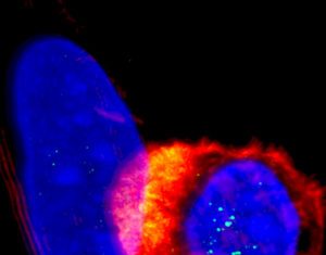 Brain Cancer CAR T Cell Therapy Guided by Scorpion Toxin Starts First Human Trial