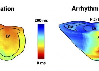 Ultrasound solves an important clinical problem in diagnosing arrhythmia