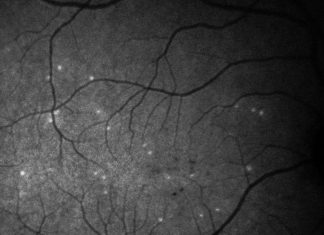 AI-supported test for very early signs of glaucoma progression