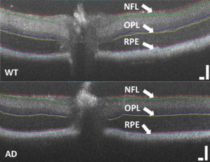 New Retinal Imaging System May Be Used to Detect an Alzheimer’s Biomarker