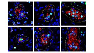 In COVID-19, Blood Clots May Form via NETosis