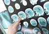 Researchers investigate new approaches to treating neurodegenerative diseases