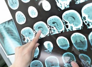 Researchers investigate new approaches to treating neurodegenerative diseases