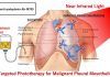 Shining light on a malignant lung cancer