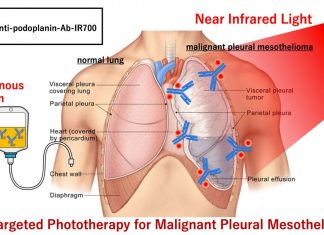 Shining light on a malignant lung cancer