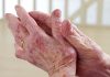 Trial results show efficacy of netakimab for treating moderate-to-severe plaque psoriasis