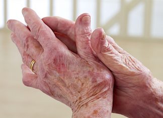 Trial results show efficacy of netakimab for treating moderate-to-severe plaque psoriasis
