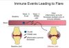 Rheumatoid Arthritis Flares Forewarned by Blood Levels of Newly Identified Cell Type