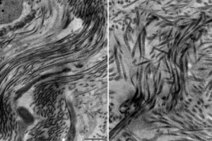 Type 5 Collagen May Determine Amount of Scarring after Heart Attack