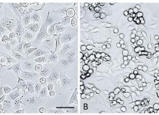 Pancreatic Cancer Therapy May Be Improved by Targeting Neuroprotein Sortilin