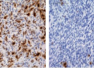 Researchers Uncover How Certain Gliomas Develop Resistance