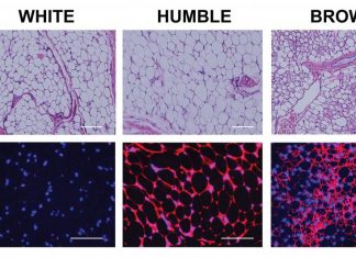 Transplanting Human Brown-Like Fat Cells May Provide Novel Therapy for Obesity and Diabetes