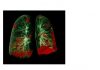 COVID-19 patients suffer long-term lung and heart damage but it can improve with time