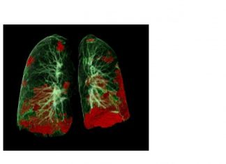 COVID-19 patients suffer long-term lung and heart damage but it can improve with time