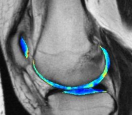 Early Detection of Osteoarthritis with Artificial Intelligence