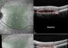 Parkinson’s Disease Drug Stabilizes Age-Related Macular Degeneration and Improves Vision