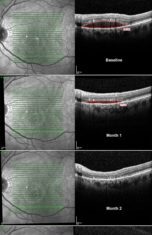 Parkinson’s Disease Drug Stabilizes Age-Related Macular Degeneration and Improves Vision