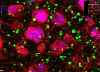 3D Tumor Model May Lead to Improved Ovarian Cancer Treatment