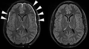 Spotting Brain Injury in the Bloodstream