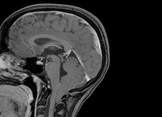 Common brain malformation traced to its genetic roots