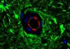 Novel Mutation in Rare Dementia Informs Alzheimer’s Therapeutics