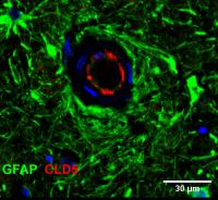 Novel Mutation in Rare Dementia Informs Alzheimer’s Therapeutics