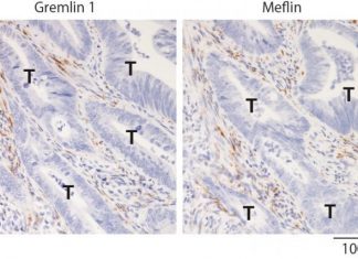 Study finds potential therapeutic targets to inhibit colorectal cancer progression
