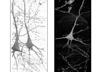 Seeing schizophrenia: X-rays shed light on neural differences, point toward treatment