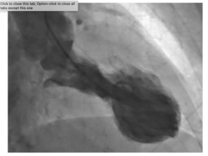 Brain Stress Linked to Broken Heart Syndrome